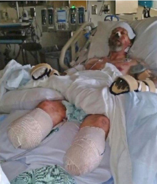 İt sahibini yaladı, kişinin bədəninə infeksiya düşdü, ayaqlarını kəsdilər - FOTO