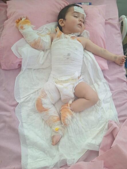 On bir aylıq Mehdi qaynar suda yanıb - FOTO