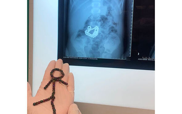 Bakıda azyaşlı uşaq 53 maqnit udub - FOTO