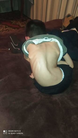 SMA xəstəsi olan bacı-qardaşın sizin köməyinizə ehtiyacı var – FOTO