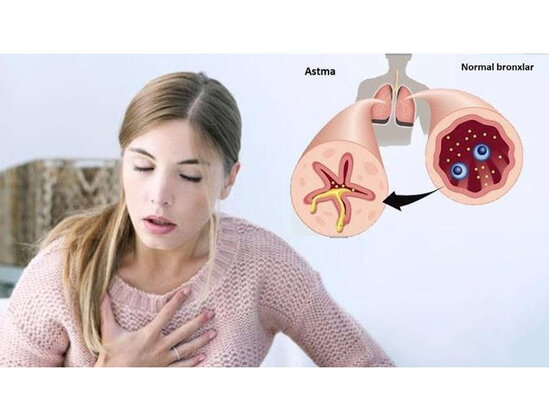 "Ata-anada bronxial astma varsa, uşaqda da ola bilər" - Səhiyyə naziri mütəxəssisi