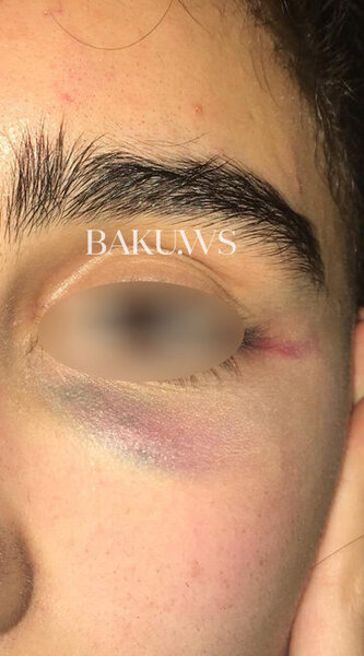 Bakı məktəbində sinif yoldaşları məktəbli qızı vəhşicəsinə döydülər - FOTO/VİDEO