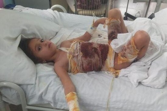 Bütün bədəni yanan 7 yaşlı Yağmur çarəsiz qalıb - FOTO