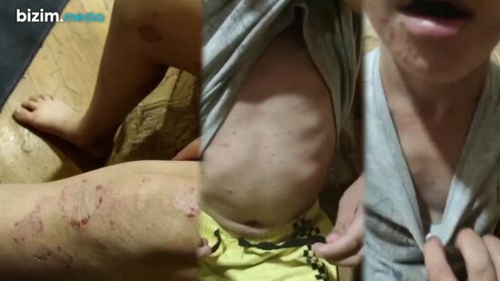 3 saylı Uşaq evində DƏHŞƏT – Yara tökən 6 yaşlı Nuray niyə həkimə APARILMIR? - VİDEO