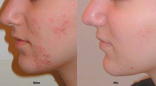 Sızanaqlardan xilas olmağın YOLLARI