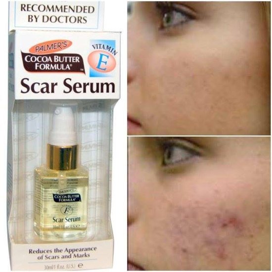 Sızanaqlardan xilas olmağın YOLLARI