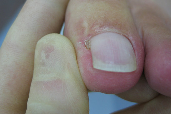 Dırnaq batması - SƏBƏBLƏR