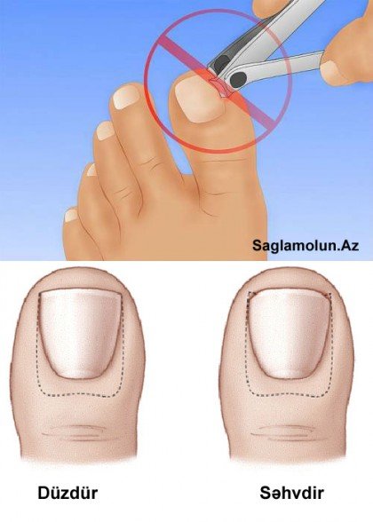 Dırnaq batması - SƏBƏBLƏR