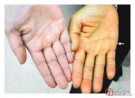 Öddə qatılaşması olanlar və piylənmədən əziyyət çəkənlər bura diqqət!!!