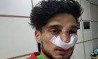 Mahir Mədətov qapıçının burnunu sındırdı — FOTO / VİDEO