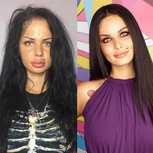 Ən böyük dodaqlı qız bu hala düşdü - FOTO