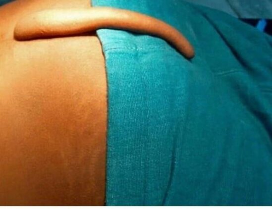 Azərbaycanda görülməmiş hadisə: 17 yaşlı oğlanda 18 sm quyruq aşkarlandı - FOTO