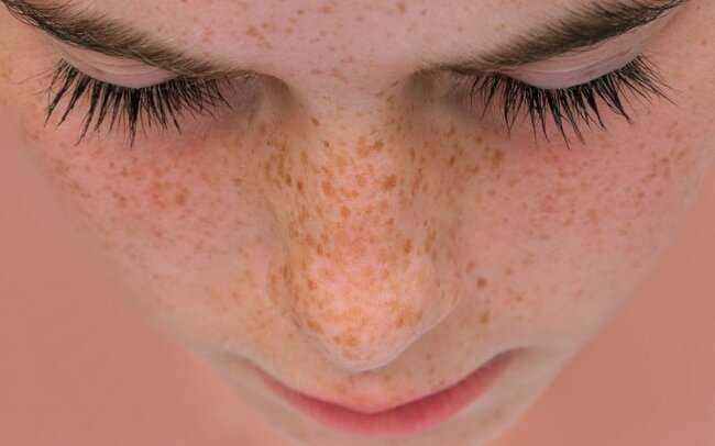 Günəşin gətirdiyi xəstəliklər – Dərinizdəki bu ləkələr nədir?