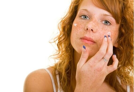 Günəşin gətirdiyi xəstəliklər – Dərinizdəki bu ləkələr nədir?