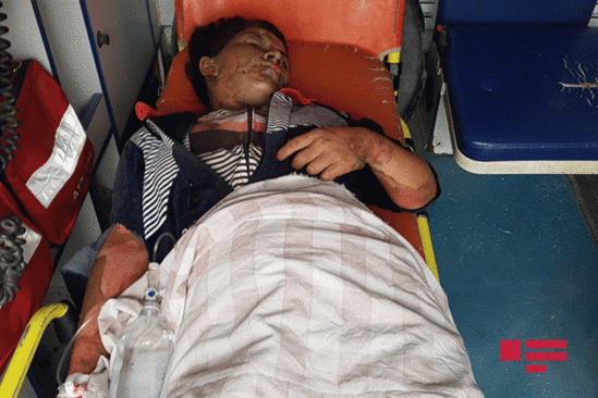 Əri tərəfindən yandırılan qadının DƏHŞƏTLİ GÖRÜNTÜSÜ - FOTO