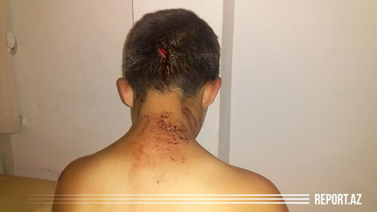 Bakıda ata dilənmək istəməyən 11 yaşlı oğlunu başından bıçaqladı - FOTO