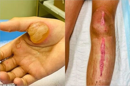 "Squid game"dəki nabatı bişirmək istəyən yeniyetmə yandı - FOTO/VİDEO