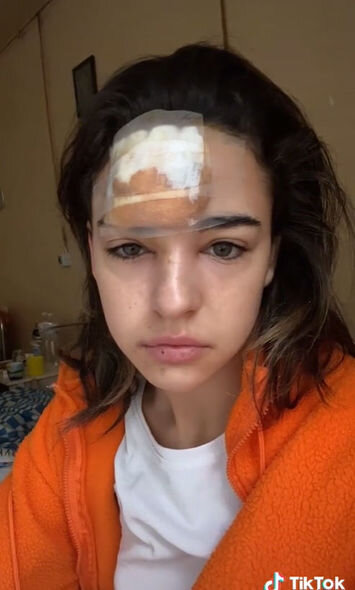 Alnındakı sızanağı sıxan qızın başında şiş yarandı - FOTO-VİDEO