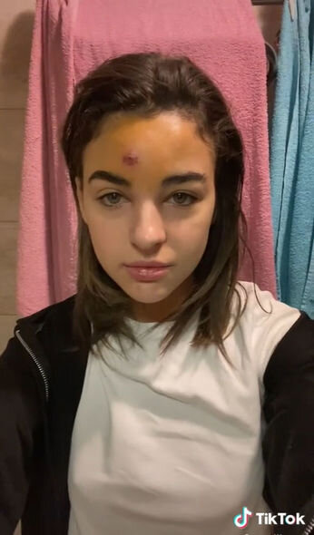 Alnındakı sızanağı sıxan qızın başında şiş yarandı - FOTO-VİDEO