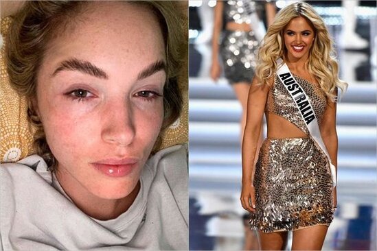 Model COVID-19-un qeyri-adi fəsadından danışdı - FOTO