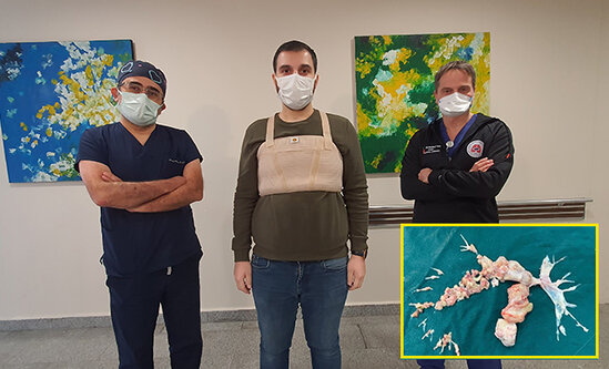 Koronavirusa yoluxduqdan sonra həyatı dəyişdi - Ağciyərlərində... - VİDEO