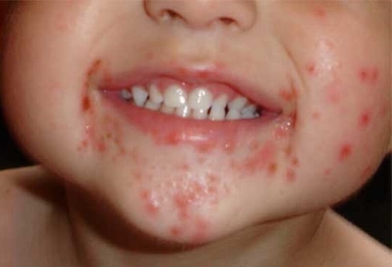 Uşaqlar arasında yeni virus yayılır: "Virusa yoluxanlar izolyasiya olunmalıdır"