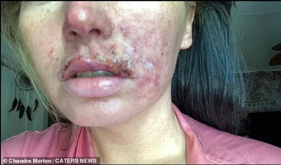 Dodağına gel doldurdu, dodağı çürüdü - FOTO