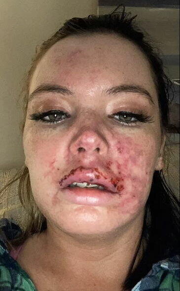 Dodağına gel doldurdu, dodağı çürüdü - FOTO