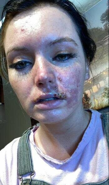 Dodağına gel doldurdu, dodağı çürüdü - FOTO