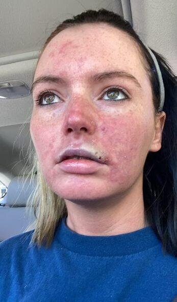 Dodağına gel doldurdu, dodağı çürüdü - FOTO