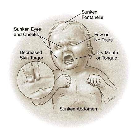 VALİDEYNLƏRİN DİQQƏTİNƏ: Uşaqlar arasında geniş yayılan Rotavirus nədir? - ARAŞDIRMA - ÖZƏL
