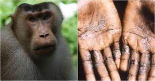 "Meymun çiçəyi" virusunun mənbəyi ORTAYA çıxdı – Görün hansı ŞƏHƏRMİŞ?