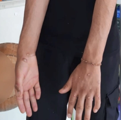 İstanbulda meymunçiçəyi təşvişi - FOTO