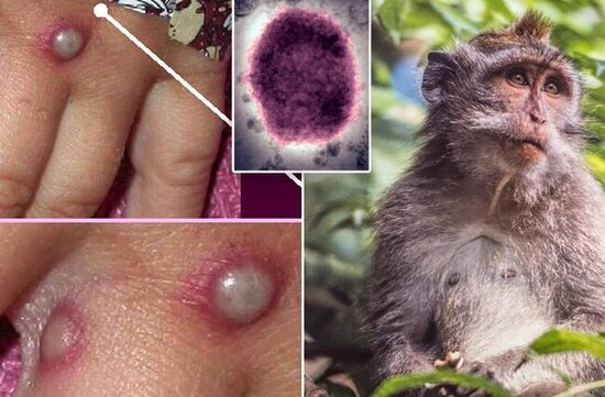 Meymunçiçəyi xəstəliyi nə dərəcədə öldürücüdür? - AÇIQLAMA - VİDEO