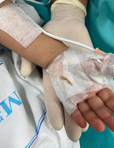 Bakıda 2 yaşlı uşaq bir il nəfəs borusunda sümük parçası ilə yaşayıb - FOTO