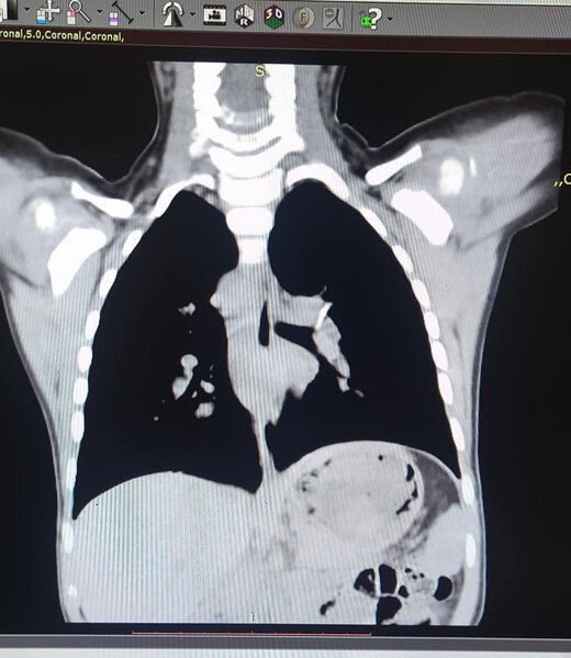 Bakıda 2 yaşlı uşaq bir il nəfəs borusunda sümük parçası ilə yaşayıb - FOTO