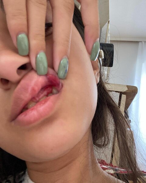 Sevgilisi azərbaycanlı blogeri döyüb - Fotolar