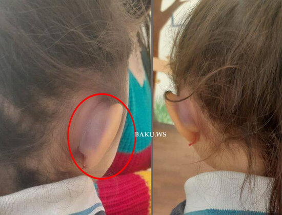 Yeddi yaşlı qız dəfələrlə şiddətə məruz qalıb - FOTO