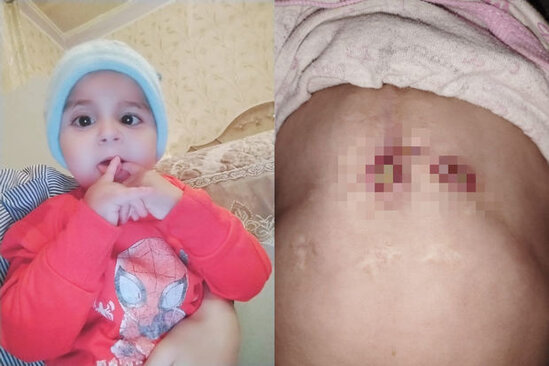 İki dəfə ürək əməliyyatı keçirən körpə Ümüdün atası: "Həkimə aparmağa imkanımız yoxdur" - FOTO