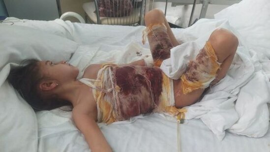 Bütün bədəni yanan 7 yaşlı Yağmur çarəsiz qalıb - FOTO