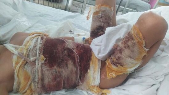 Bütün bədəni yanan 7 yaşlı Yağmur çarəsiz qalıb - FOTO