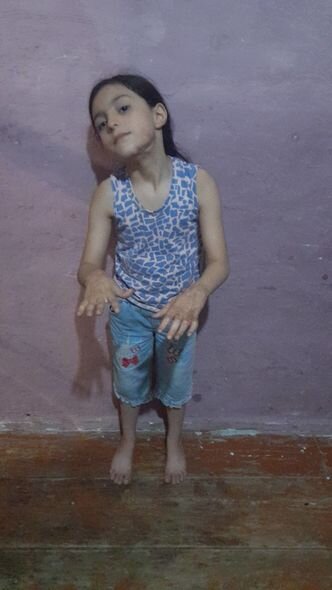 Əlləri yanan azyaşlının anası: "Bakıya gəlmək üçün qapı-qapı gəzib yolpulu axtardım, tapmadım" - FOTO