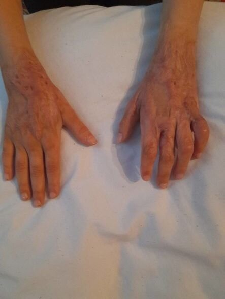 Əlləri yanan azyaşlının anası: "Bakıya gəlmək üçün qapı-qapı gəzib yolpulu axtardım, tapmadım" - FOTO