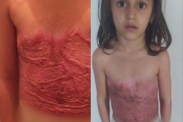 Yeddi yaşlı məktəbli qız ağır yanıq xəsarətləri alıb - FOTO