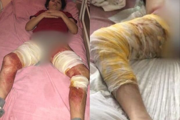 İmkansızlıqdan qızımın yarasını bağlamağa bint ala bilmirik: Zülfiyyənin sizin köməyinizə ehtiyacı var - FOTO