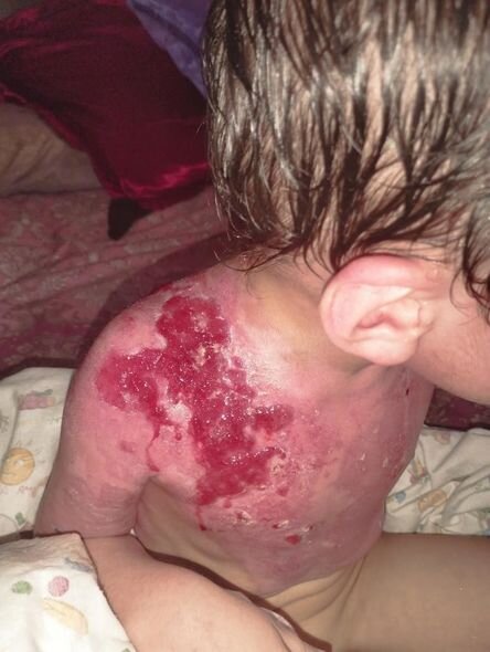 Dəhşətli faciə ilə üzləşən iki azyaşlı qardaşın yardımınıza ehtiyacı var - FOTO