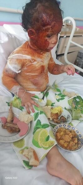 Başından aşağı qaynar su tökülən 3 yaşlı Xədicənin sizin köməyinizə ehtiyacı var - FOTO