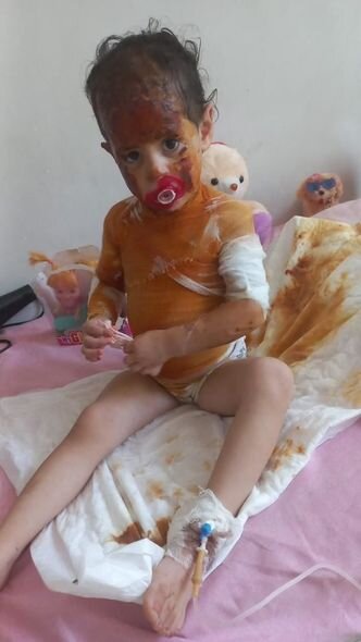 Başından aşağı qaynar su tökülən 3 yaşlı Xədicənin sizin köməyinizə ehtiyacı var - FOTO