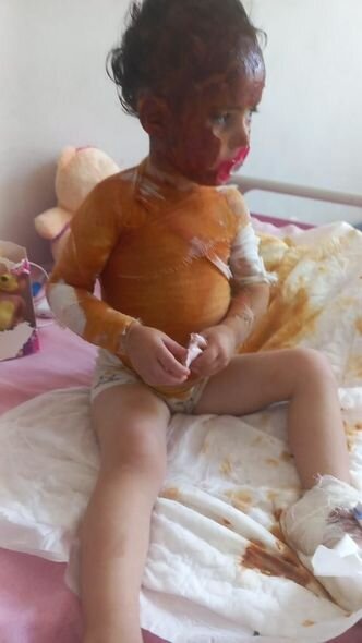 Başından aşağı qaynar su tökülən 3 yaşlı Xədicənin sizin köməyinizə ehtiyacı var - FOTO