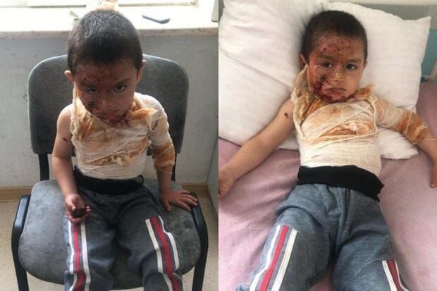 Dörd yaşlı Rəvanın başından aşağı qaynar su tökülüb - FOTO